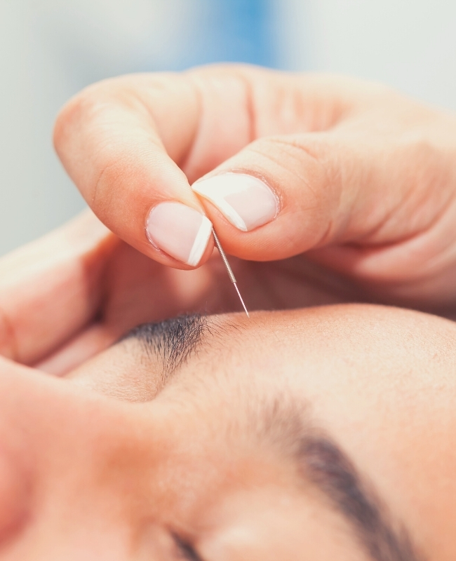 Kobieta podczas akupunktury twarzy